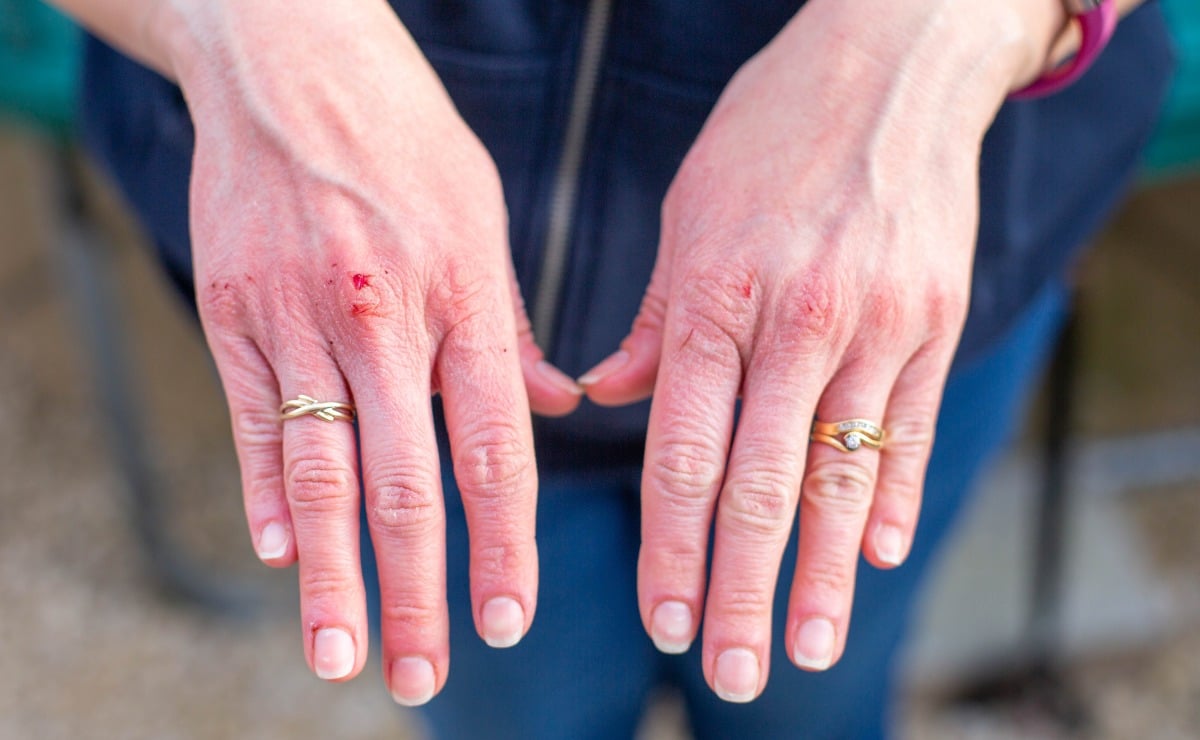 Signs and Symptoms of Methamphetamine Abuse